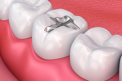 Aberdeen Family Dentistry | Ceramic Crowns, Dentures and Periodontal Treatment
