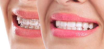 Aberdeen Family Dentistry | Dentures, Teeth Whitening and Dental Fillings