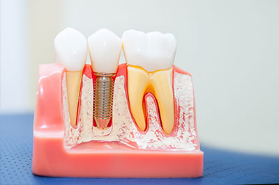 Aberdeen Family Dentistry | Teeth Whitening, Dental Cleanings and Veneers