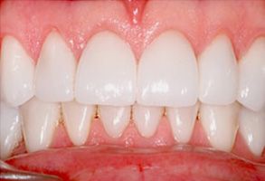 Aberdeen Family Dentistry | Dental Bridges, Dentures and Veneers