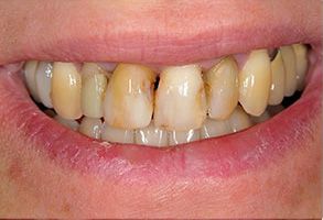 Aberdeen Family Dentistry | Invisalign reg , Dental Cleanings and Dentures