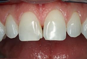 Aberdeen Family Dentistry | Veneers, Implant Dentistry and Dentures
